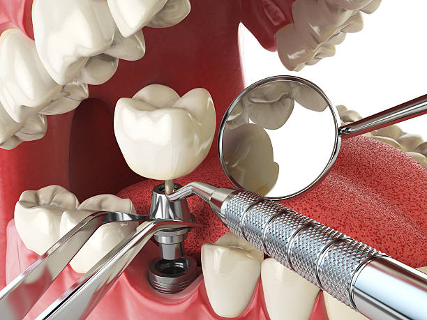 Best Emergency Root Canal Treatment in Freeland, WA